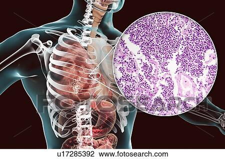 Lobar pneumonia, illustration and light micrograph View Large Photo Image Stock Image - Lobar pneumonia, illustration and light micrograph. Fotosearch