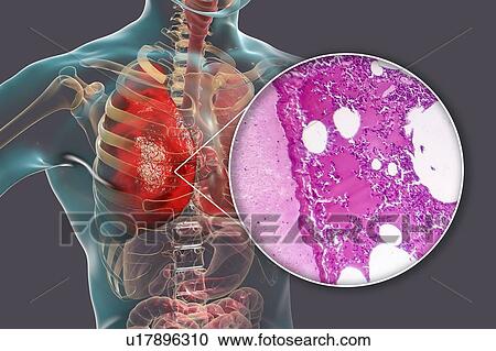 Stock Image - Lobar pneumonia, illustration and light micrograph. Fotosearch