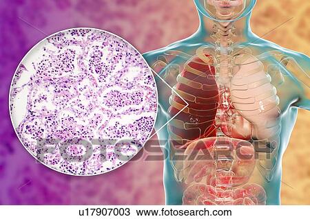 Lobar pneumonia, illustration and light micrograph View Large Photo Image Stock Image - Lobar pneumonia, illustration and light micrograph. Fotosearch