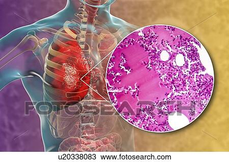 Lobar pneumonia, illustration and light micrograph View Large Photo Image Stock Image - Lobar pneumonia, illustration and light micrograph. Fotosearch