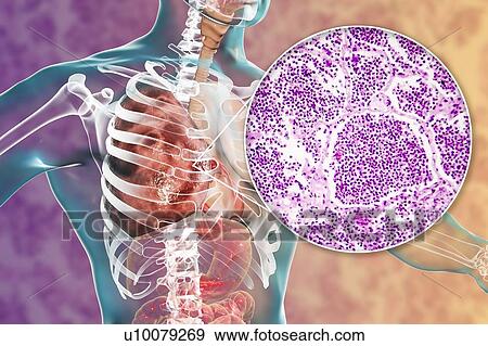 Stock Photo - Lobar pneumonia, illustration and light micrograph. Fotosearch