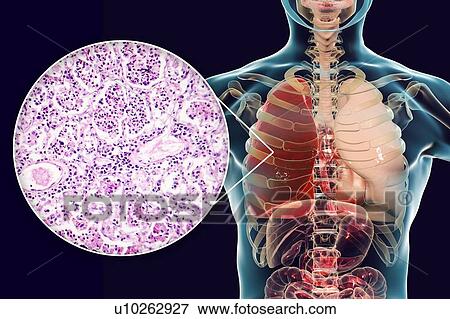Lobar pneumonia, illustration and light micrograph View Large Photo Image Stock Photo - Lobar pneumonia, illustration and light micrograph. Fotosearch