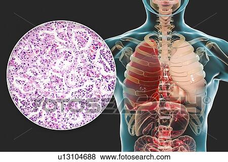 Stock Photo - Lobar pneumonia, illustration and light micrograph. Fotosearch