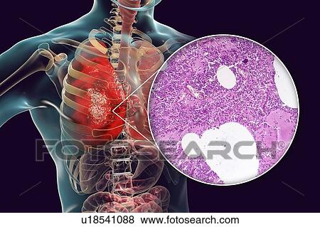 Stock Photo - Lobar pneumonia, illustration and light micrograph. Fotosearch