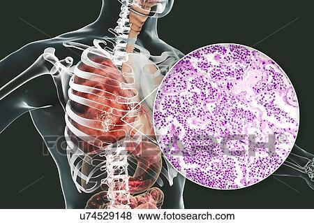 Stock Photo - Lobar pneumonia, illustration and light micrograph. Fotosearch