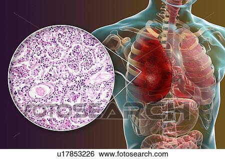 Lobar pneumonia, illustration and light micrograph View Large Photo Image Stock Photograph - Lobar pneumonia, illustration and light micrograph. Fotosearch