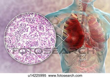 Stock Photography - Lobar pneumonia, illustration and light micrograph. Fotosearch