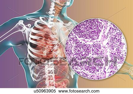 Stock Photography - Lobar pneumonia, illustration and light micrograph. Fotosearch
