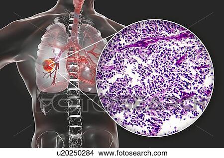 Picture - Lung cancer, composite image. Fotosearch