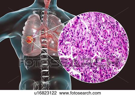 Stock Image - Lung cancer, composite image. Fotosearch