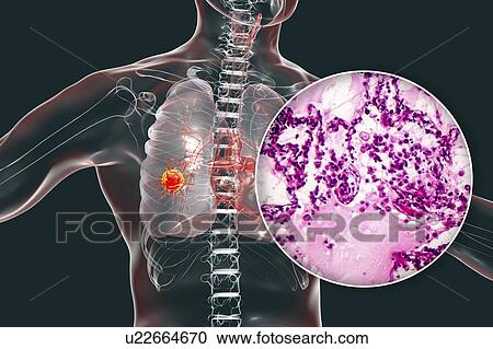 Stock Image - Lung cancer, composite image. Fotosearch