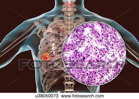Stock Image - Lung cancer, composite image. Fotosearch