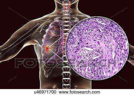 Stock Image - Lung cancer, composite image. Fotosearch