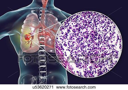 Stock Image - Lung cancer, composite image. Fotosearch