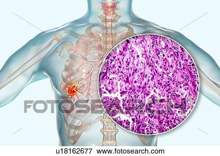 Stock Photo - Lung cancer, composite image. Fotosearch