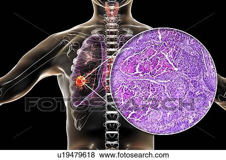 Lung cancer, composite image View Large Photo Image Stock Photo - Lung cancer, composite image. Fotosearch