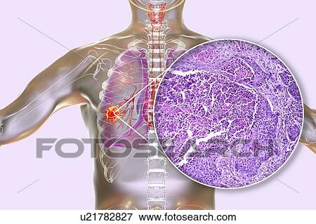 Stock Photo - Lung cancer, composite image. Fotosearch