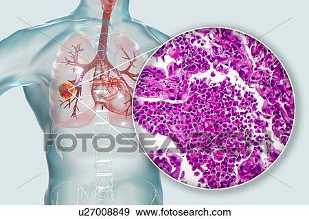 Stock Photo - Lung cancer, composite image. Fotosearch