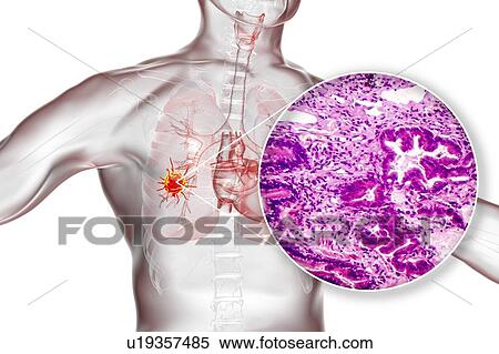 Stock Photography - Lung cancer, composite image. Fotosearch