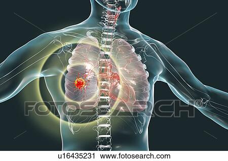 Stock Image - Lung cancer, conceptual image. Fotosearch