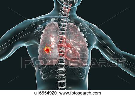 Stock Image - Lung cancer, conceptual image. Fotosearch