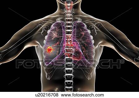 Lung cancer, conceptual image View Large Photo Image Stock Photo - Lung cancer, conceptual image. Fotosearch