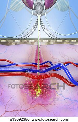 Malaria transmission, illustration View Large Photo Image Stock Photograph - Malaria transmission, illustration. Fotosearch