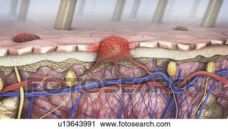Melanoma, illustration View Large Photo Image Stock Image - Melanoma, illustration. Fotosearch