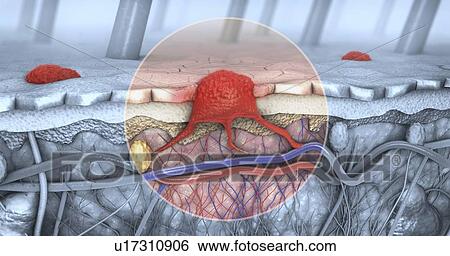 Stock Photograph - Melanoma, illustration. Fotosearch