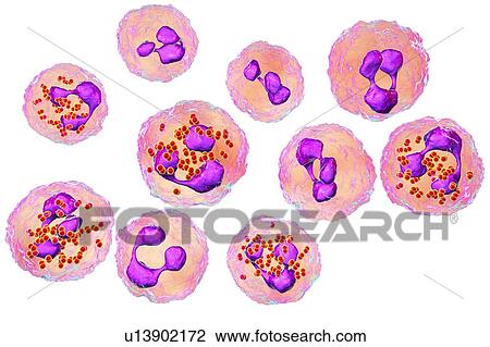 Stock Image - Meningococcal meningitis, illustration. Fotosearch