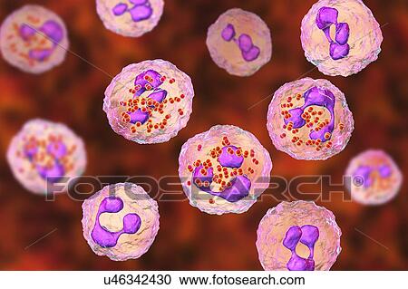 Stock Image - Meningococcal meningitis, illustration. Fotosearch
