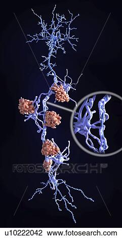 Nerve damage in multiple sclerosis, illustration View Large Photo Image Stock Image - Nerve damage in multiple sclerosis, illustration. Fotosearch