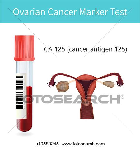 Stock Photography - Ovarian cancer blood test, illustration. Fotosearch