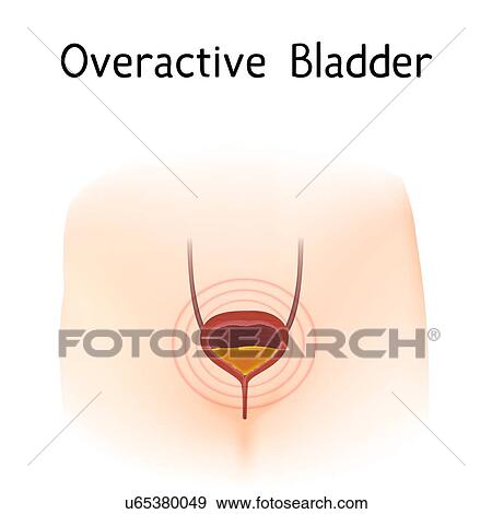 Overactive bladder, illustration View Large Photo Image Stock Photo - Overactive bladder, illustration. Fotosearch