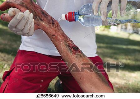 Stock Photo - Paramedic cooling third degree burns with water. Fotosearch