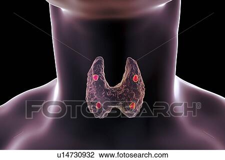 Parathyroid glands, illustration View Large Photo Image Stock Image - Parathyroid glands, illustration. Fotosearch