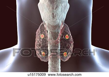 Stock Photo - Parathyroid glands, illustration. Fotosearch