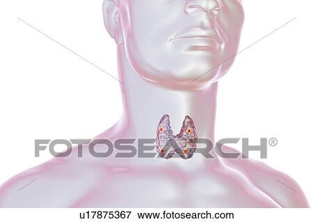 Parathyroid glands, illustration View Large Photo Image Stock Photo - Parathyroid glands, illustration. Fotosearch