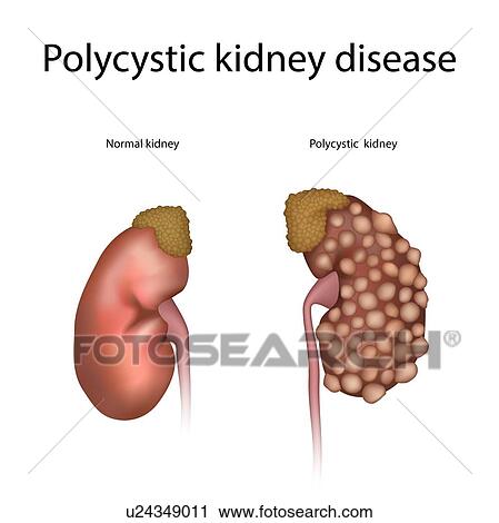 Polycystic kidney disease, illustration View Large Photo Image Stock Image - Polycystic kidney disease, illustration. Fotosearch