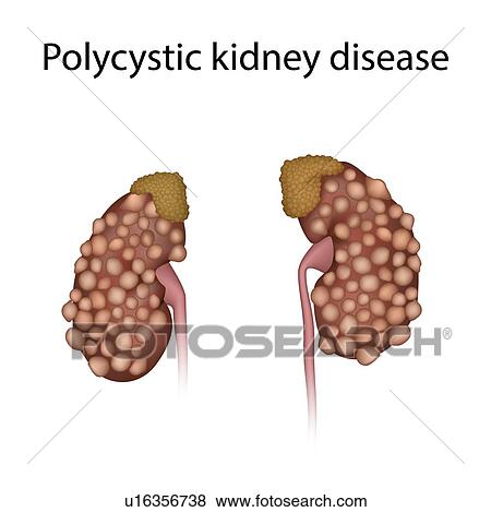 Polycystic kidney disease, illustration View Large Photo Image Stock Photo - Polycystic kidney disease, illustration. Fotosearch