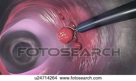 Polyp removal, illustration View Large Photo Image Picture - Polyp removal, illustration. Fotosearch
