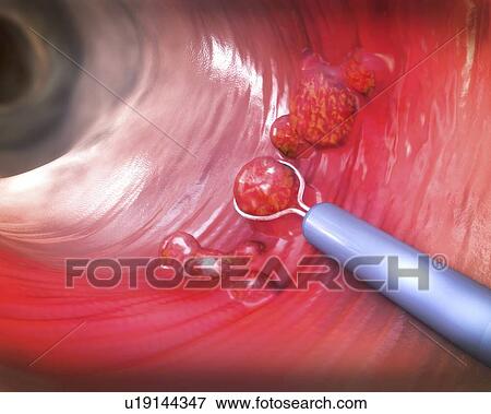 Polyp removal, illustration View Large Photo Image Stock Photo - Polyp removal, illustration. Fotosearch