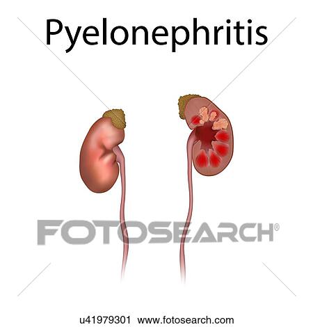 Stock Image - Pyelonephritis, illustration. Fotosearch