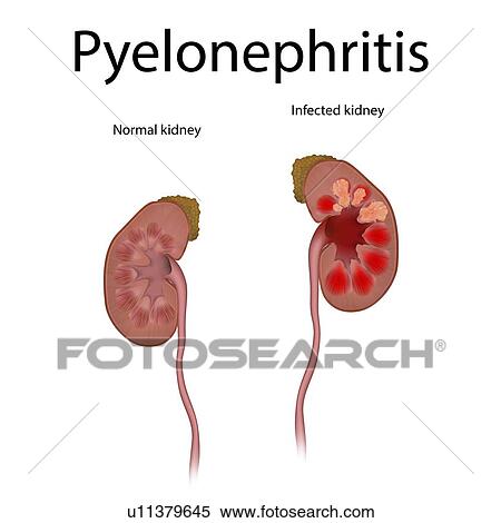 Stock Photography - Pyelonephritis, illustration. Fotosearch