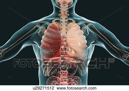 Stock Image - Red hepatisation of lobar pneumonia, conceptual illustration. Fotosearch