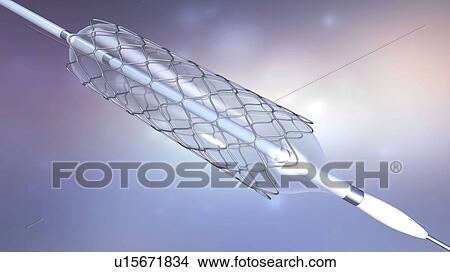 Stent and balloon catheter, illustration View Large Photo Image Picture - Stent and balloon catheter, illustration. Fotosearch