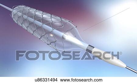 Stent and balloon catheter, illustration View Large Photo Image Picture - Stent and balloon catheter, illustration. Fotosearch