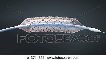 Stent and balloon catheter, illustration View Large Photo Image Stock Image - Stent and balloon catheter, illustration. Fotosearch