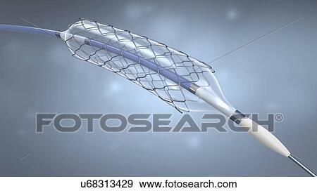 Stent and balloon catheter, illustration View Large Photo Image Stock Photo - Stent and balloon catheter, illustration. Fotosearch