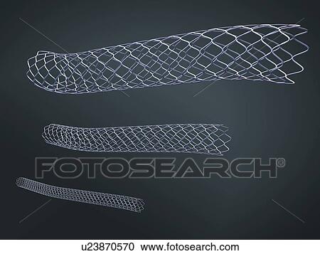 Stock Image - Stent, illustration. Fotosearch